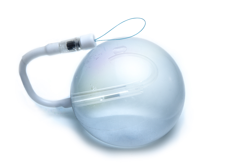 Adjustable Intragastric Balloon – Endosurgery (ESB) – Leading ...