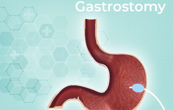 Gastrostomy